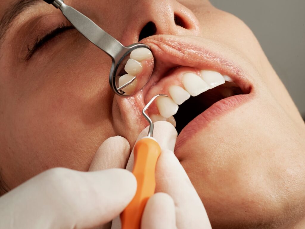 A dentist carefully placing a dental filling in a patient's molar using professional dental instruments.